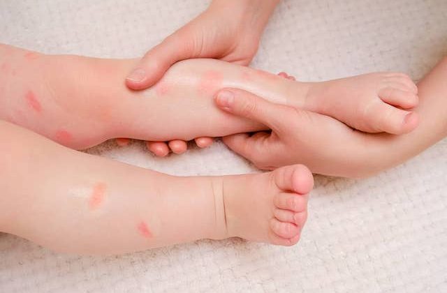 Allergies in Children — Common Questions and Concerns